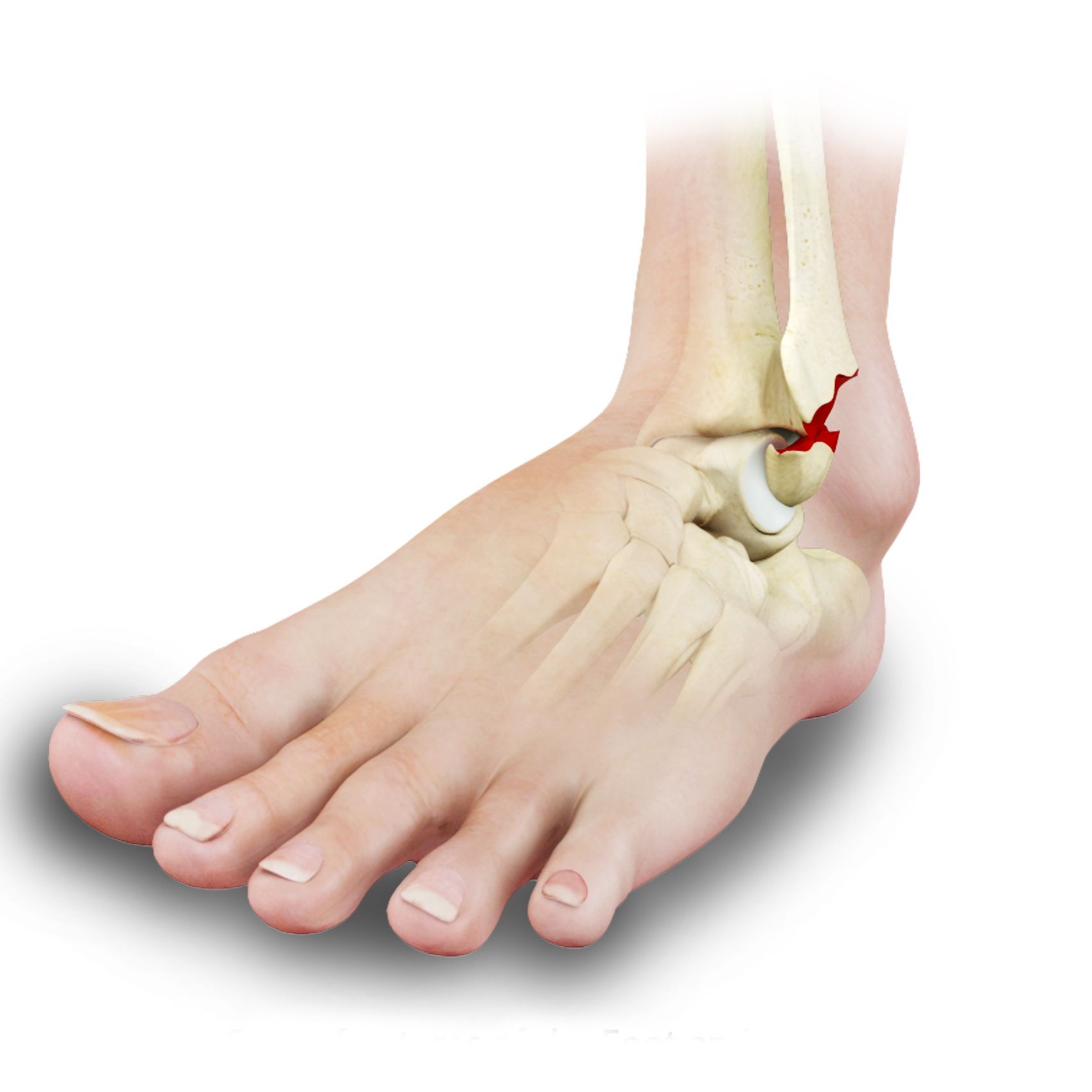 Ankle Fracture Repair Los Angeles | Broken Ankle Glendale | Pasadena