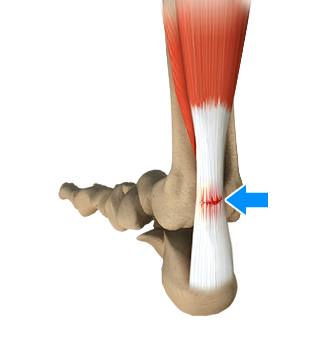 Calf Muscle Tear - FootEducation