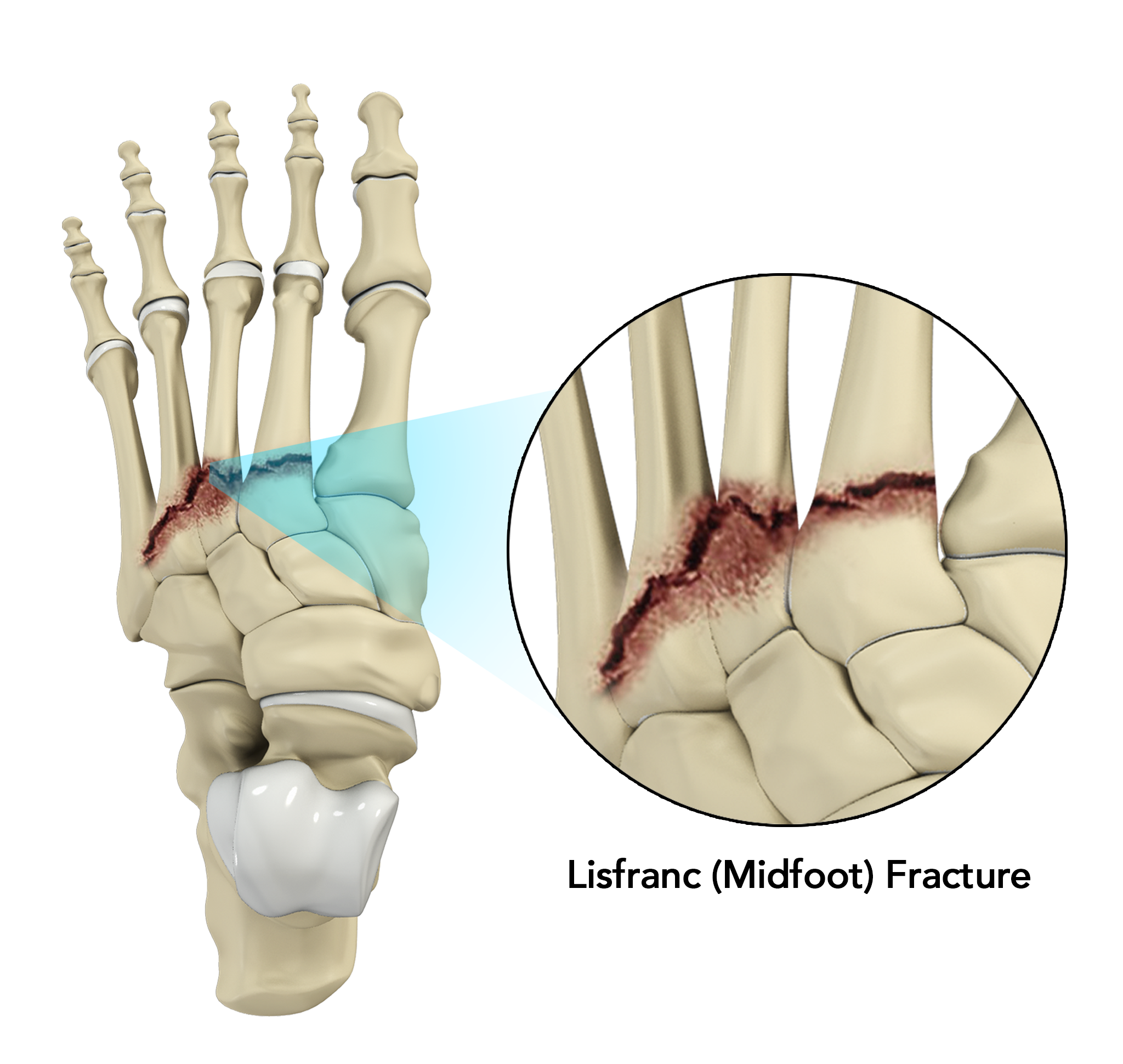 lisfranc injury treatment
